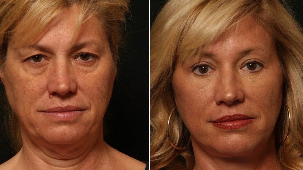 Facelift Patient